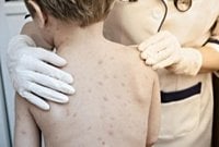 Vaccine-Preventable  Diseases Make a Comeback