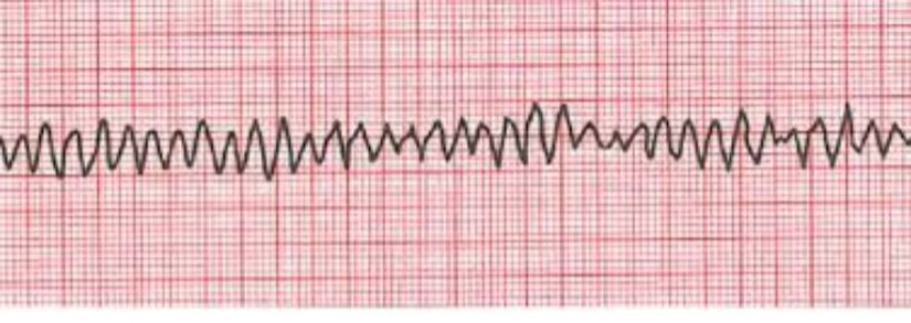 ventriküler fibrilasyon