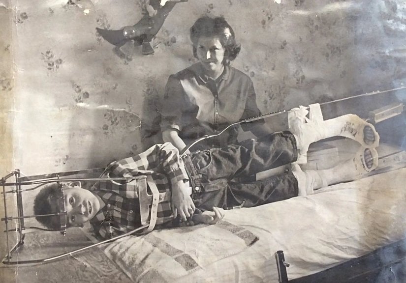 Çocuk Felci hastalarına uygulanması gereken tedavi.