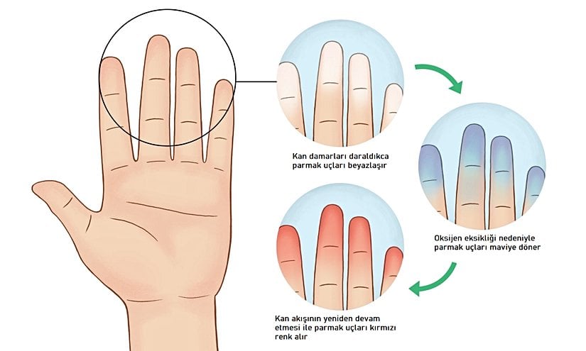 Raynaud hastalığının renk değişimi evreleri