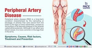 Rheumatoid Arthritis Linked To Increased Risk Of Peripheral Artery Disease