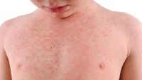 Western Australia faces worst measles outbreak in past five years