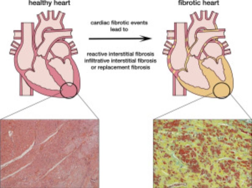 Kardiyak fibrozis
