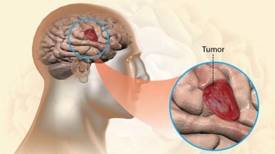 Gliablastoma Tipi Beyin Kanseri, Düşüncelerinizden Besleniyor Olabilir!