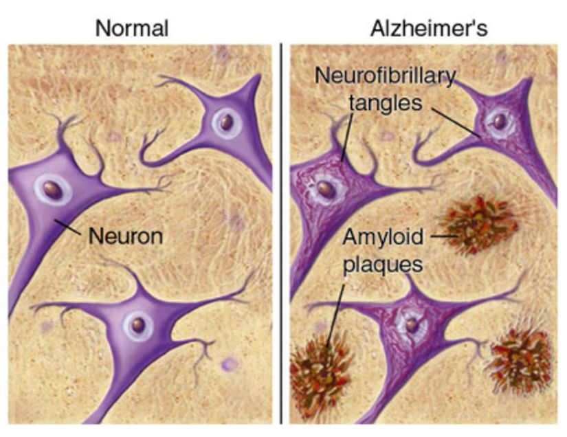 Beta-amiloid plakları ve nörofibriler yumaklar