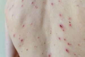UK Rolls Out Free Chickenpox Vaccine For Children