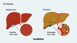 Machine Learning Model Predicts Hepatorenal Syndrome Risk In Cirrhosis