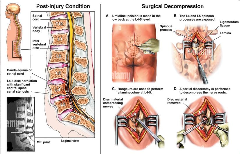 (solda) Lomber disk herniasyonu ve sorunlu bölgenin bir MRI filmi. (sağda) L4 -L5 düzeyinde laminektomi ve diskektomi ile ilgili cerrahi adımlar.