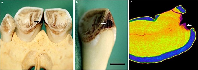 Bir Mona maymununun üst sağ orta keser dişinde izlenen çürük