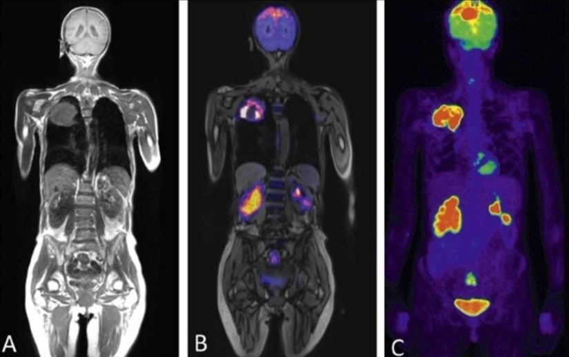 Sırasıyla; MRI, CT ve PET taramalarının karşılaştırması.