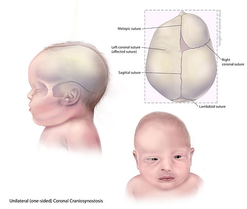 Baller-Gerold Sendromu