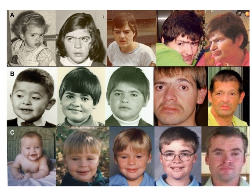 Brakisefali, geniş aralıklı gözler, sinofriz/kemerli kaşlar, orta yüz retrüzyonu, çıkıntılı dil, alt dudağın vermilyonunun dışa dönmesi ve çene prognatizminden oluşan karakteristik yüz profilini gösteren etkilenen bireylerin fotoğrafları. Farklı yaşlarda interstisyel 9q34.3 mikrodelesyonu olan üç farklı insan (A, B, ve C satırları), yaşla birlikte değişim gösterir.