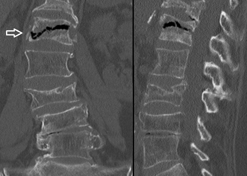 78 yaşındaki bir kadının BT taramasının koronal ve sagital düzlemleri . Omur içi vakum yarık işareti (beyaz ok) avasküler nekrozun bir işaretidir. Bir vertebral kompresyon kırığından sonra bir vertebral cismin avasküler nekrozu Kümmel Hastalığı olarak adlandırılır.