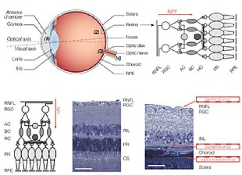 Retinal Implant