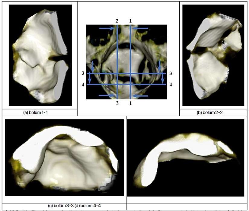 Şekil 5. İki ağız plakasının kesitleri: (a) parasagital düzlemde, bölüm 1-1, (b) parasagital düzlemde, bölüm 2-2, (c)  enine düzlemde, bölüm 3-3 ve (d) enine düzlemde, bölüm 4-4 ortadaki resimde gösterildiği gibi.