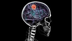 Beyin Kanseri, Kafatasının Bazı Kısımlarını Eritebilir!