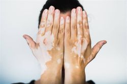 Vitiligoyu kontrol ederek bunu  cilt güzelliğine uygun  bir araç haline getirebilir miyiz...?