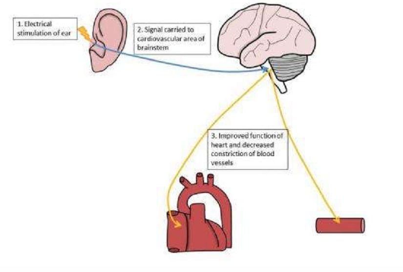 Kulak yolunun başlangıcında bulunan &quot;tragus&quot; bölgesine verilen elektriksel darbelerin ortaya çıkardığı sistem şematize edilmiştir