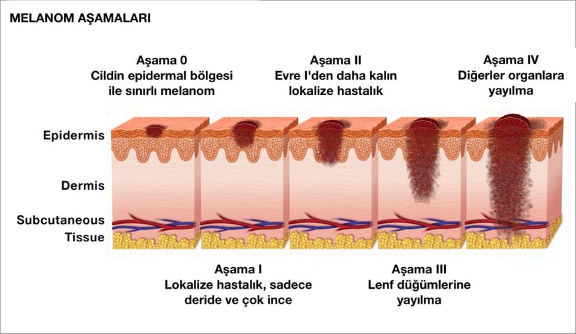 Melanom'un Aşamaları