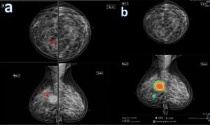 High Rate Of False-Positive Mammography Results Found