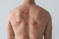 Warning issued after new mpox strain identified in England