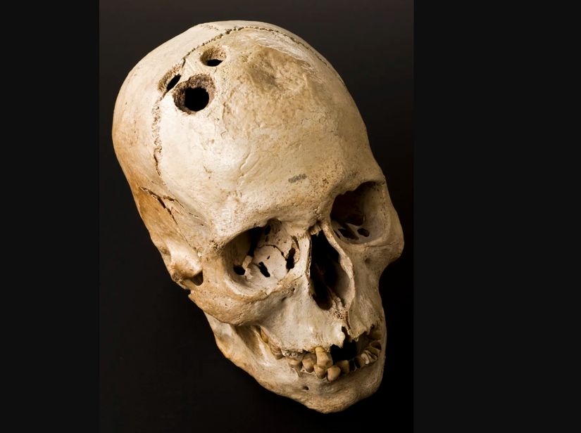 1958 yılında İsrail'in Eriha kentindeki bir mezardan çıkarılan bu kafatası, antik cerrahi yöntem olan trepanasyonla açılmış dört ayrı deliği göstermektedir.