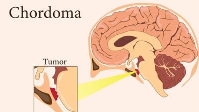 Kordoma Kanseri Nedir? Embriyonun Ölümcül Artığı Nasıl Oluşur ve Nasıl Tedavi Edilir?