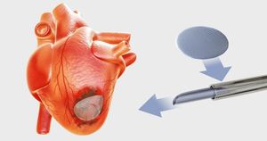 Scientists Develop Lab-Grown Heart Patches To Repair Damage