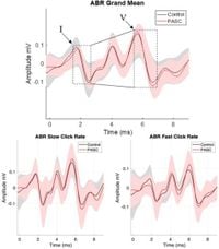 Altered auditory brainstem responses are post-acute sequela of SARS-CoV-2 (PASC) - Scientific Reports