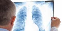 Sanidad confirma el resurgimiento de la silicosis en España: recomienda considerar la prohibición del cuarzo en las encimeras