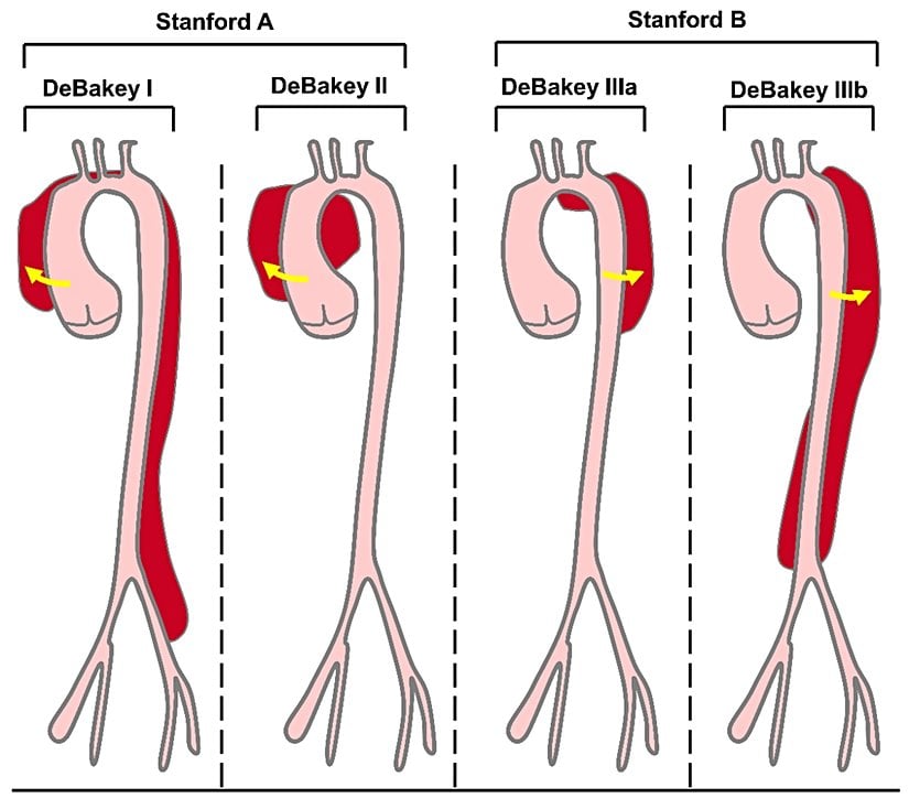 DeBakey Tip I ve II diseksiyonlar Stanford A, Debakey Tip III diseksiyonlar Stanford B olarak adlandırılır.