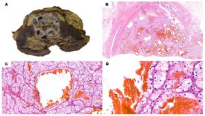 BBOX1 Restraints TBK1-mTORC1 Oncogenic Signaling In CcRCC