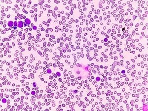 Gene Therapy Breakthrough Frees Patients From Deadly Cancer