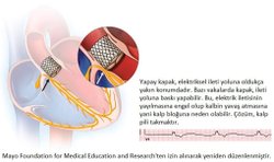 TAVI Nedir?