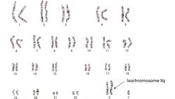 İzokromozom Nedir? Uzun veya Kısa Kolları Hatalı Kopyalanmış Kromozomlar Nasıl Oluşur?