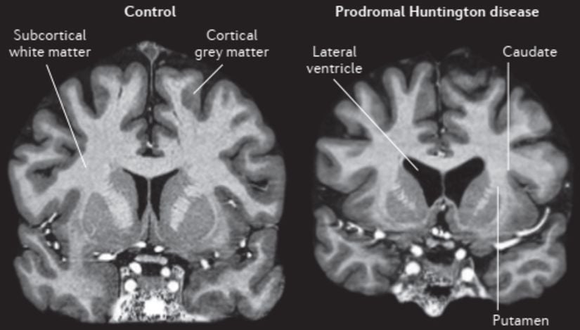 Prodromal Huntington hastalığında atrofi, 7T MRI kullanılarak gösterilmiştir. Kontrol ile karşılaştırıldığında gen taşıyıcısında kaudat ve putamenin bilateral atrofisi ve sıvı ile dolu lateral ventrikül boyutunda eş zamanlı bir artış gözlenir. Bu prodromal katılımcının yalnızca belirgin Huntington hastalığını teşhis etmek için yetersiz olan ince belirti ve semptomları vardır. Ayrıca kortikal gri cevherde ve subkortikal beyaz cevherin genel atrofisinde ince değişiklikler vardır.