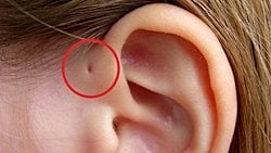 Preauriküler Sinüs: Kulağınızın Üzerinde Küçük Bir Delik mi Var? Bunun Evrimsel Bir Nedeni Olabilir!
