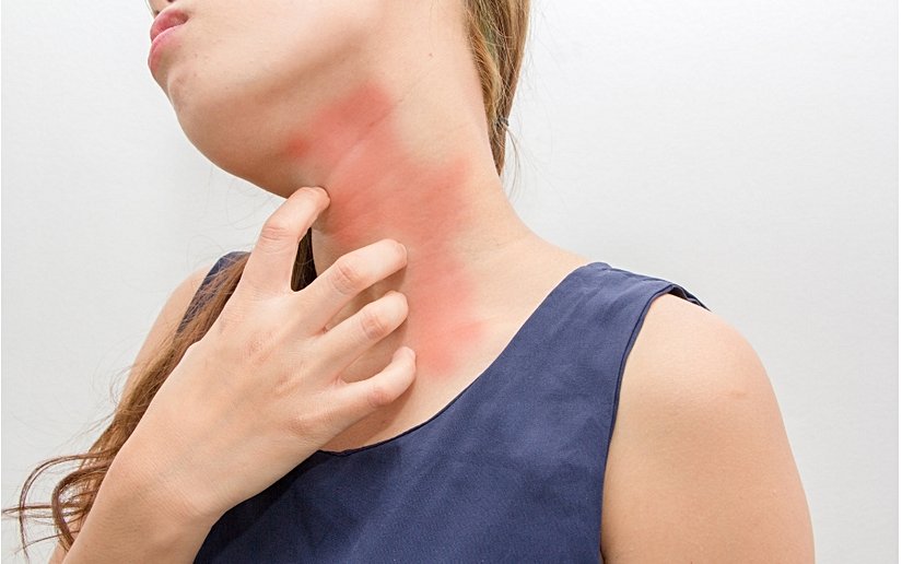 Histamin intoleransı cilt semptomları.