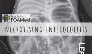 Echocardiography May Predict Necrotizing Enterocolitis Severity