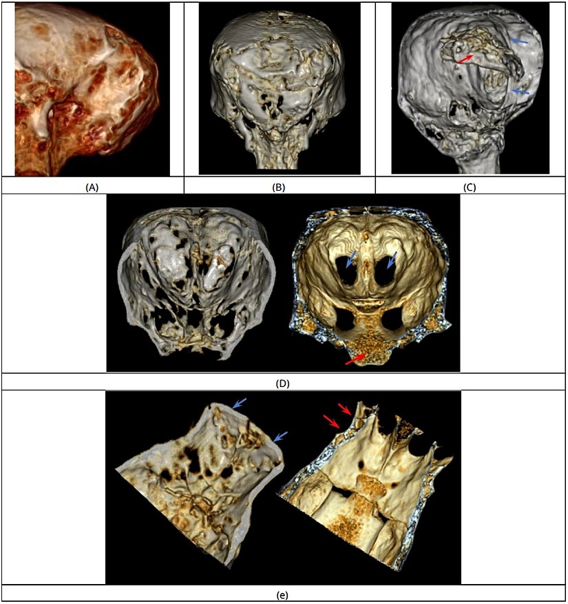 Şekil 12. Josephina'nın oksipital bölgesi. (a) Kemik koyu tonlarda boş alanları gösteren yandan görünüm. (b) Kemik  yapısının arkadan görünüşü. (c) İç yapının gözlemlenmesine olanak sağlayan ve daha yumuşak biyolojik materyalin  gözlemlenmesi için geliştirilmiş kafatası bölümü; kırmızı ok beyin kalıntılarını, mavi oklar ise ortadaki ayırıcı kemik  yapısını göstermektedir. (d)-(e) Josephina (solda) ve lamanın (sağda) kafatasından alınan kesitin yan yana  karşılaştırılması. (d) Koronal bölüm.  Mavi oklar lama (fossae ethmoidale) üzerinde Josephina'da görülmeyen oyukları göstermektedir. Kırmızı ok, lamanın  üzerindeki kalın süngerimsi kemiği gösteriyor; Josephina'da bulunmuyor; muhtemelen bozulmuş ve gitmiş. (e) Enine  kesit. Mavi oklar Josephina'nın kafatasındaki lamada bulunmayan kemiği gösteriyor. Kırmızı oklar, bu noktada  Josephina'nınkiyle karşılaştırıldığında lama kemiğinin büyük bir farklılığını gösteriyor.