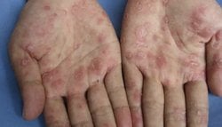 Sifiliz hastalığı ve belirtileri