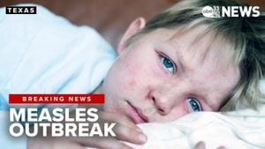 Health Authorities Respond To Rising Measles Cases In Mexico