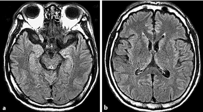 Wernicke ensefalopatisinin iyileşme sürecinde T2 FLAIR MRI görüntüleri. (a) Hipotalamustaki hiperintensitenin kaybolması. (b) Talamusun her iki yarısının medial bölgelerindeki hiperintensitenin kaybolması. Bu bulgular, Wernicke ensefalopatisinin gerilemesini ve Korsakoff sendromunun olası kalıcı bilişsel etkilerini gösterir. Talamus ve mamiller cisimler gibi diencephalon yapılarının hasarı, hastalarda belirgin retrograd amneziye yol açabilir. Bu durum, hastaların geçmiş olayları hatırlamada güçlük çekmesine neden olur ve özellikle zamansal gradyan etkisi ile daha yakın geçmişteki anılar daha fazla etkilenebilir.