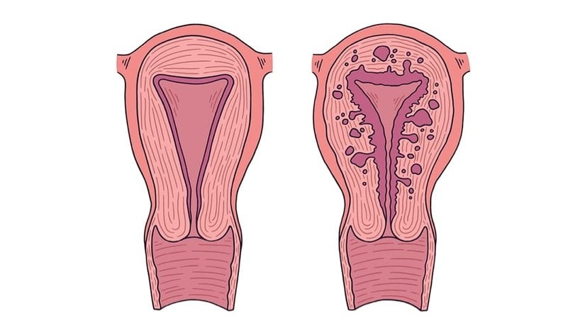 Adenomyozis