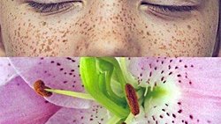 Ephelitler ve Güneş Lentigoları(bizim bildiğimiz adlarıyla çiller)