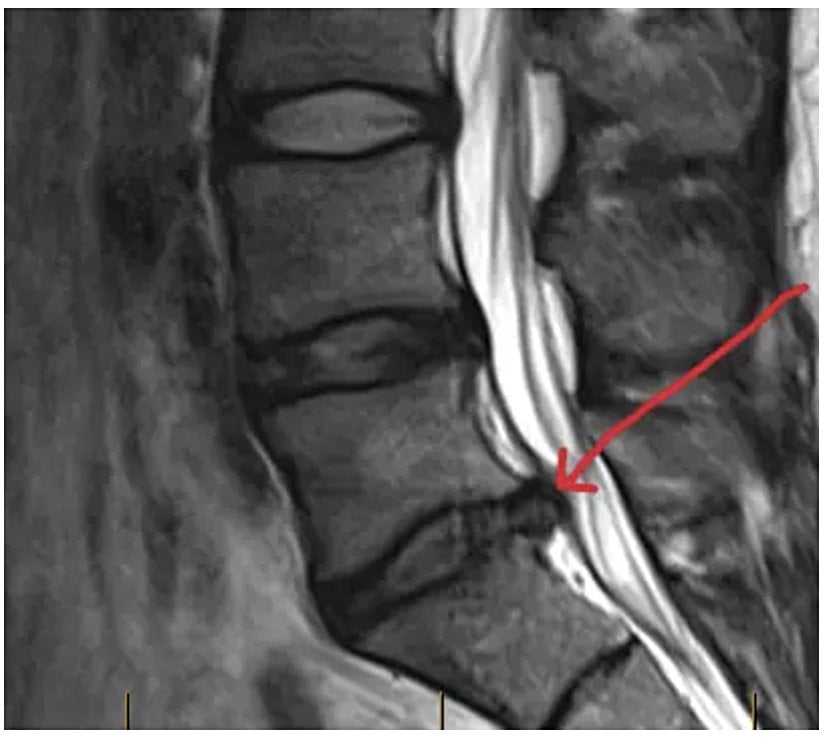 Bir bel fıtığının MR görüntüsü.