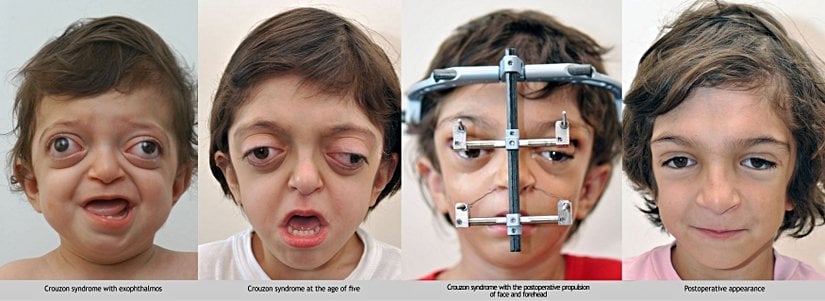 Crouzon Syndrome
