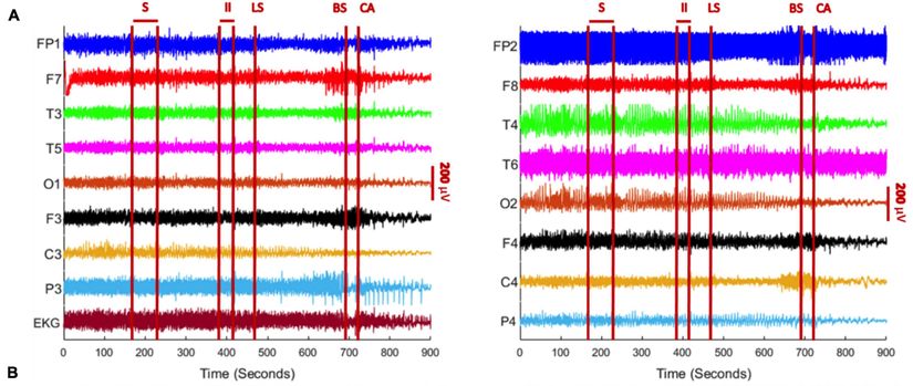 Bu grafikte, sol taraftaki grafik sol beynin, sağ taraftaki grafik sağ beynin faaliyetini göstermektedir. Bu grafikler, her iki tarafta 8'erden toplam 16 ayrı elektrottan gelen elektrik sinyalleri yansıtmaktadır. Grafikte, en altta EKG olarak isimlendirilmiş grafik ise hastanın kalbinden toplanan sinyallerdir. Grafiklerde zaman, soldan sağa doğru akmaktadır.