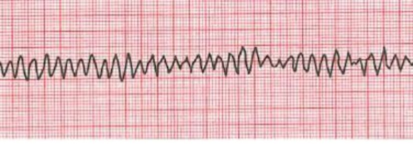 ventriküler fibrilasyon