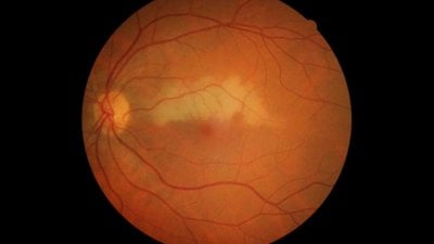 Santral Retinal Arter Tıkanıklığı Nedir? Belirtileri ve Tedavi Seçenekleri Nelerdir?